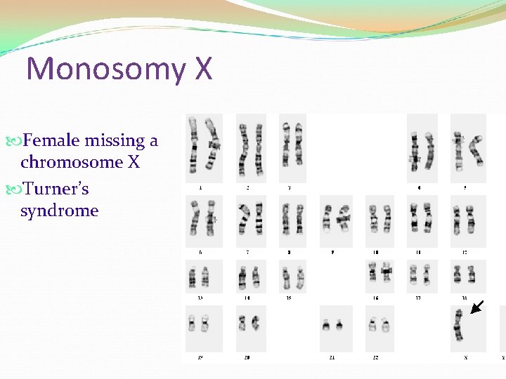 Monosomy X Female missing a chromosome X Turner’s syndrome 