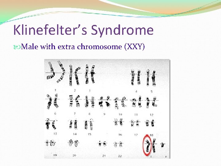 Klinefelter’s Syndrome Male with extra chromosome (XXY) 