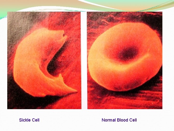 Sickle Cell Normal Blood Cell 
