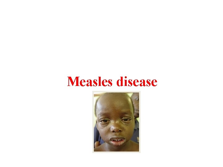 Measles disease 