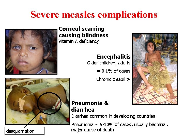 Severe measles complications Corneal scarring causing blindness Vitamin A deficiency Encephalitis Older children, adults