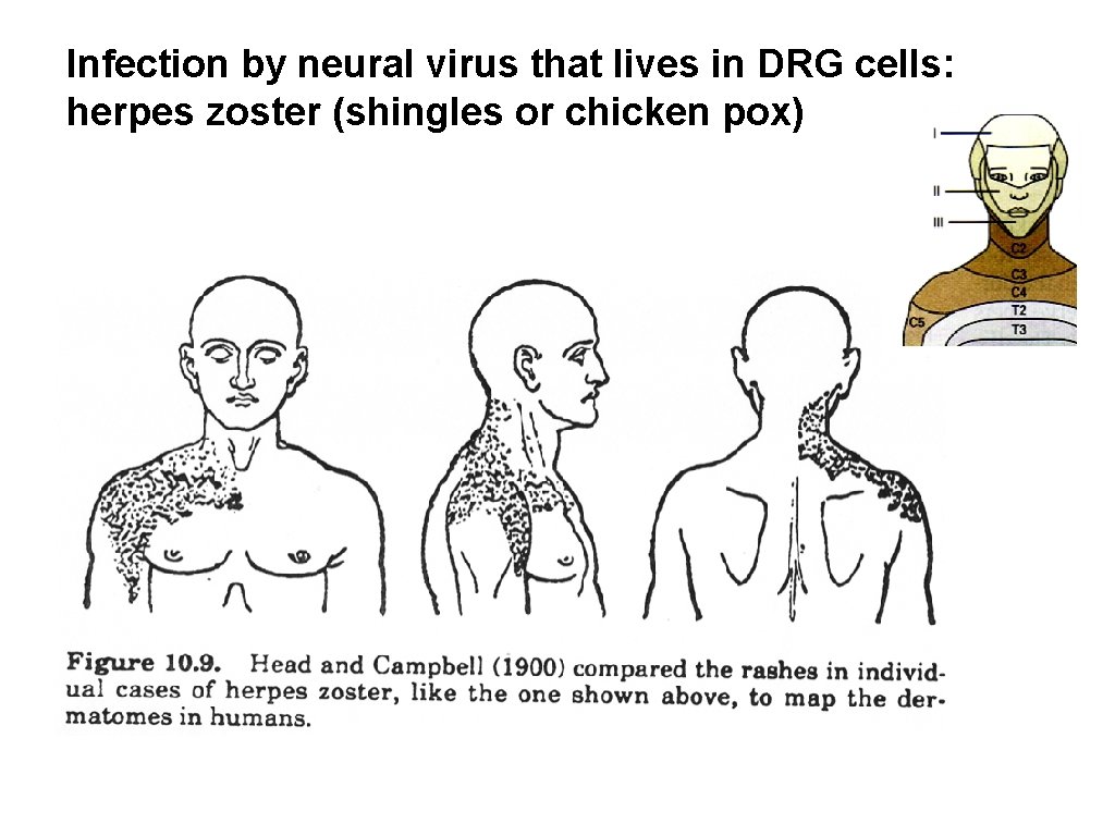 Infection by neural virus that lives in DRG cells: herpes zoster (shingles or chicken Infection by neural virus that lives in DRG cells: herpes zoster (shingles or chicken