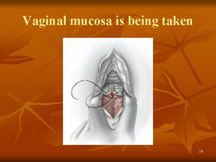 Vaginal mucosa is being taken 14 