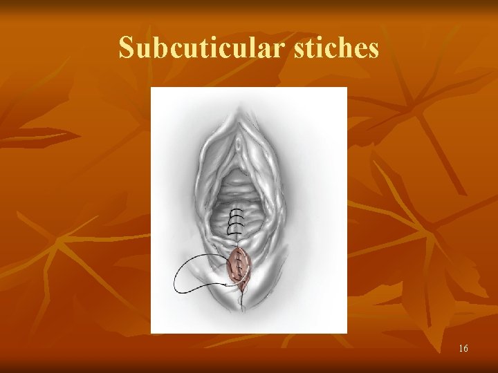 Subcuticular stiches 16 