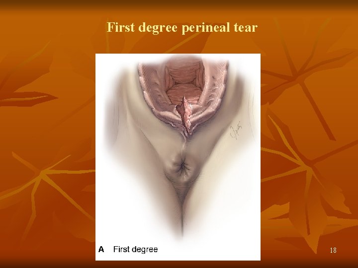 First degree perineal tear 18 