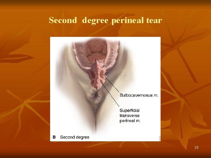 Second degree perineal tear 19 