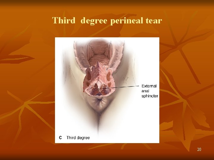 Third degree perineal tear 20 