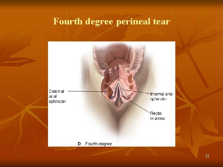 Fourth degree perineal tear 21 