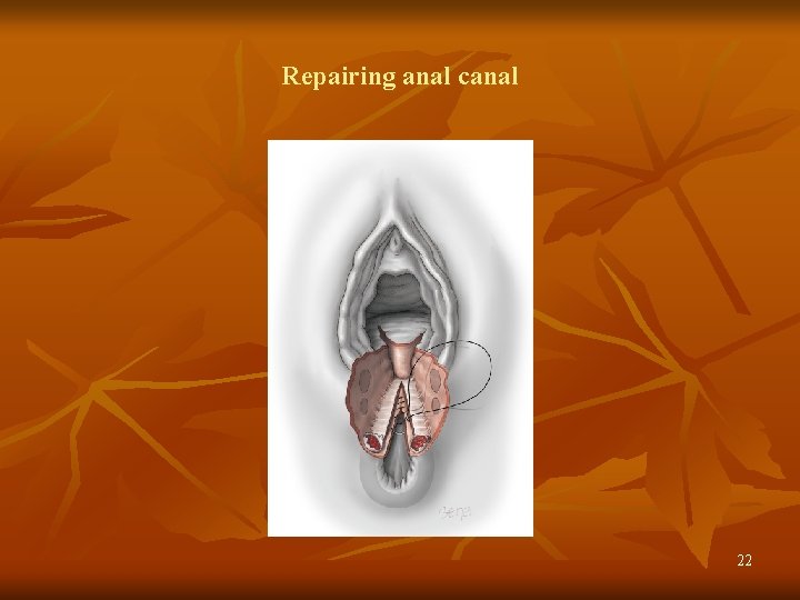 Repairing anal canal 22 