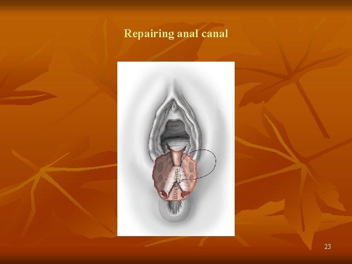 Repairing anal canal 23 
