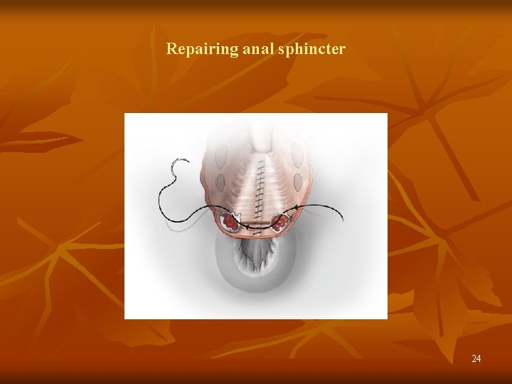 Repairing anal sphincter 24 