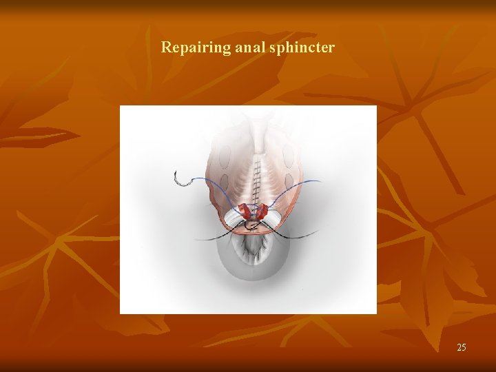 Repairing anal sphincter 25 
