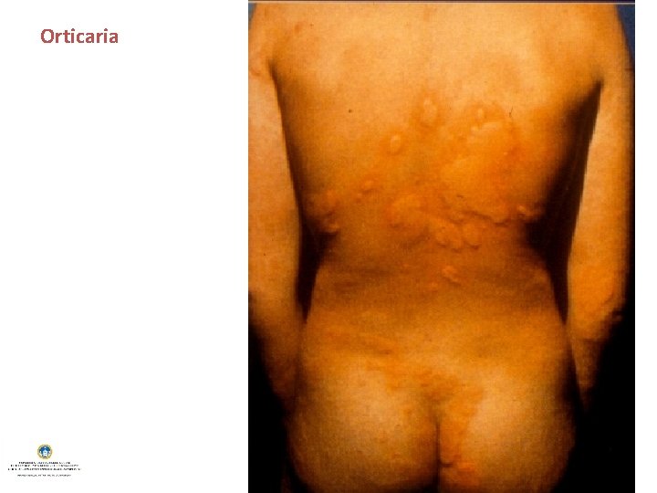 Orticaria 