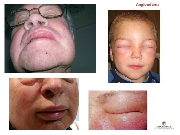 Angioedema 