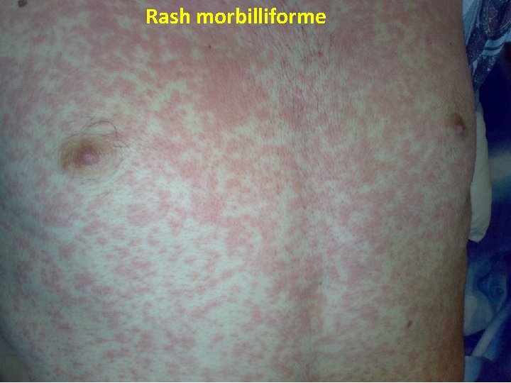 Rash morbilliforme 