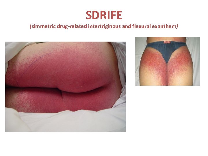 SDRIFE (simmetric drug-related intertriginous and flexural exanthem) 