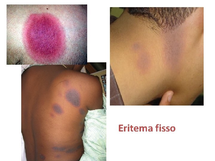 Eritema fisso 