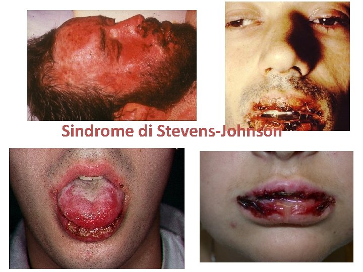 Sindrome di Stevens-Johnson 