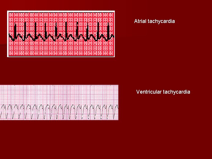 Atrial tachycardia Ventricular tachycardia Atrial tachycardia Ventricular tachycardia