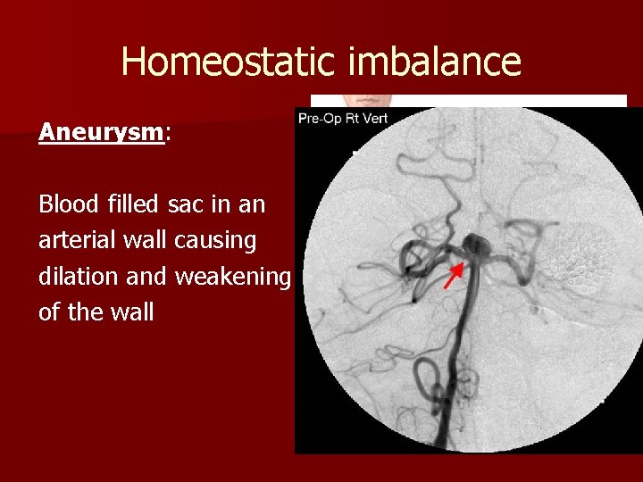 Homeostatic imbalance Aneurysm: Blood filled sac in an arterial wall causing dilation and weakening Homeostatic imbalance Aneurysm: Blood filled sac in an arterial wall causing dilation and weakening
