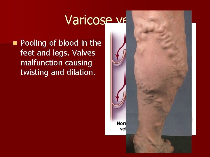 Varicose veins n Pooling of blood in the feet and legs. Valves malfunction causing Varicose veins n Pooling of blood in the feet and legs. Valves malfunction causing