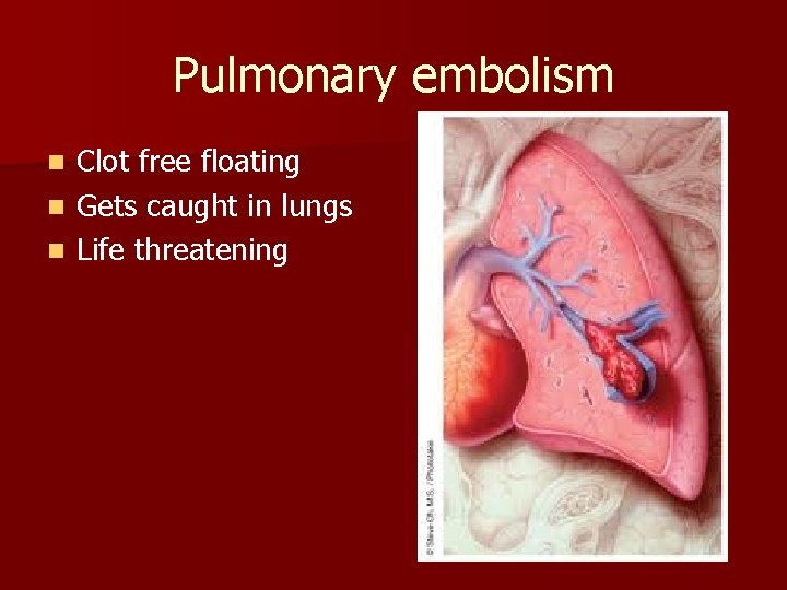Pulmonary embolism Clot free floating n Gets caught in lungs n Life threatening n Pulmonary embolism Clot free floating n Gets caught in lungs n Life threatening n