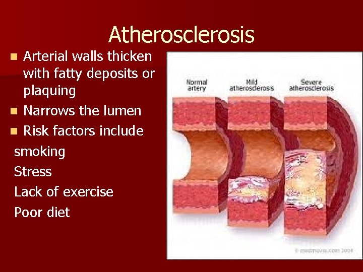 Atherosclerosis Arterial walls thicken with fatty deposits or plaquing n Narrows the lumen n Atherosclerosis Arterial walls thicken with fatty deposits or plaquing n Narrows the lumen n
