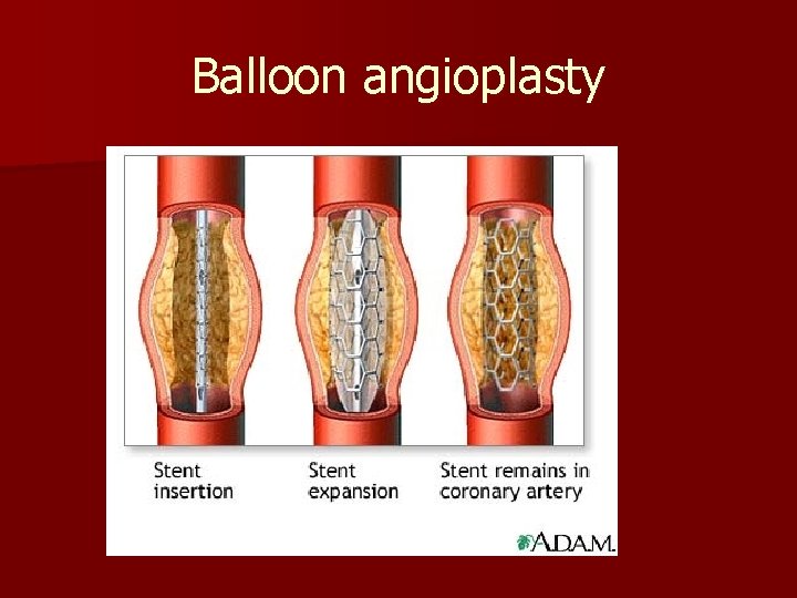 Balloon angioplasty Balloon angioplasty
