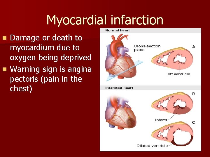 Myocardial infarction Damage or death to myocardium due to oxygen being deprived n Warning Myocardial infarction Damage or death to myocardium due to oxygen being deprived n Warning