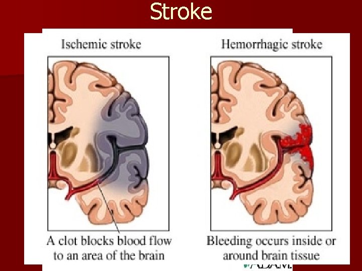 Stroke Stroke