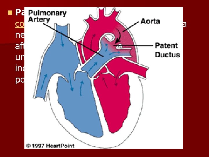 n Patent ductus arteriosus (PDA) is a congenital disorder in the heart wherein a n Patent ductus arteriosus (PDA) is a congenital disorder in the heart wherein a