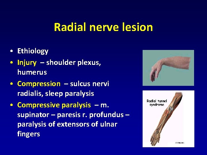 Radial nerve lesion • Ethiology • Injury – shoulder plexus, humerus • Compression – Radial nerve lesion • Ethiology • Injury – shoulder plexus, humerus • Compression –