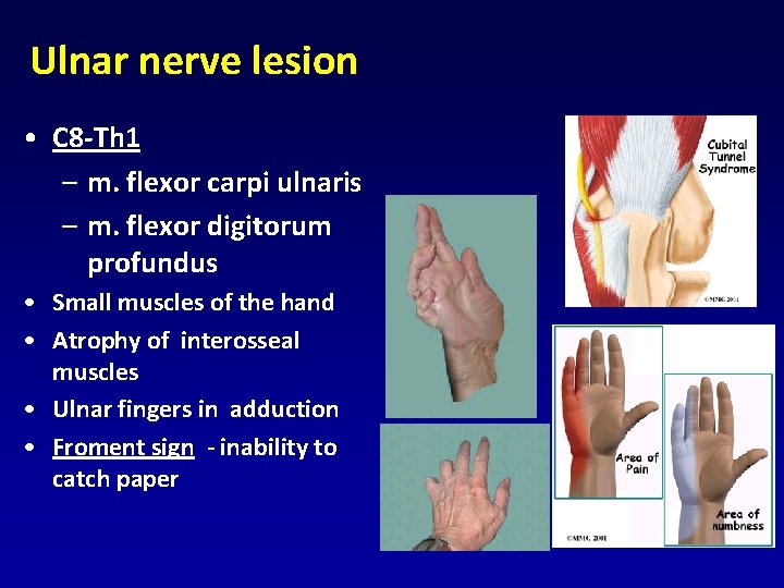 Ulnar nerve lesion • C 8 -Th 1 – m. flexor carpi ulnaris – Ulnar nerve lesion • C 8 -Th 1 – m. flexor carpi ulnaris –