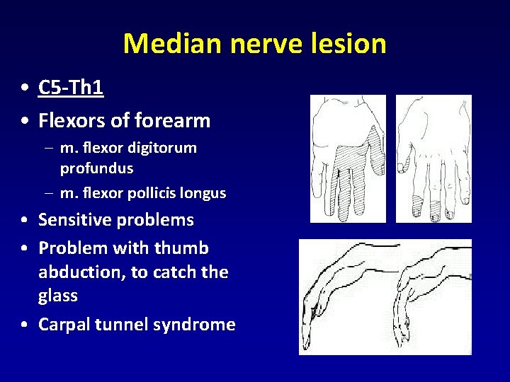 Median nerve lesion • C 5 -Th 1 • Flexors of forearm – m. Median nerve lesion • C 5 -Th 1 • Flexors of forearm – m.