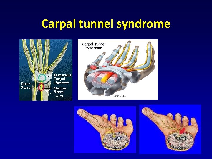 Carpal tunnel syndrome Carpal tunnel syndrome