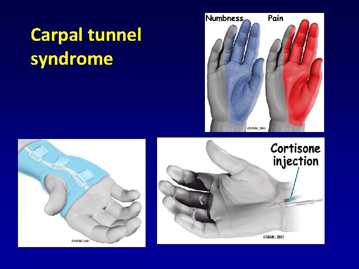 Carpal tunnel syndrome Carpal tunnel syndrome