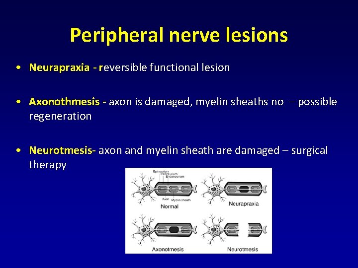 Peripheral nerve lesions • Neurapraxia - reversible functional lesion • Axonothmesis - axon is Peripheral nerve lesions • Neurapraxia - reversible functional lesion • Axonothmesis - axon is