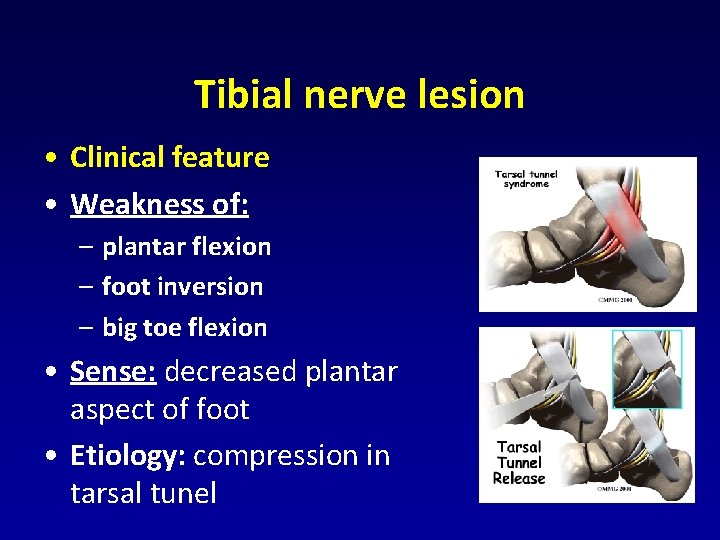 Tibial nerve lesion • Clinical feature • Weakness of: – plantar flexion – foot Tibial nerve lesion • Clinical feature • Weakness of: – plantar flexion – foot