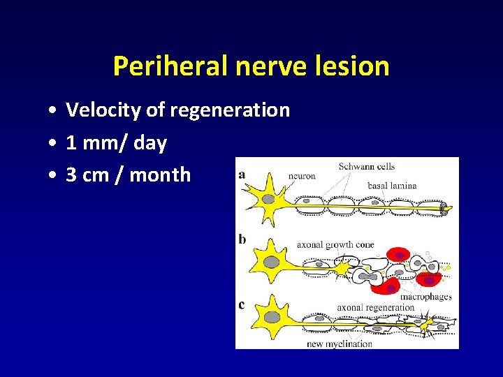 Periheral nerve lesion • Velocity of regeneration • 1 mm/ day • 3 cm Periheral nerve lesion • Velocity of regeneration • 1 mm/ day • 3 cm