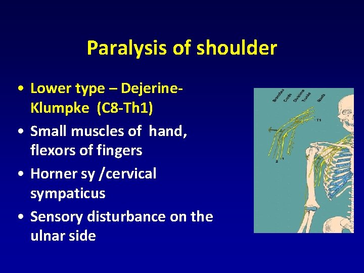 Paralysis of shoulder • Lower type – Dejerine. Klumpke (C 8 -Th 1) • Paralysis of shoulder • Lower type – Dejerine. Klumpke (C 8 -Th 1) •