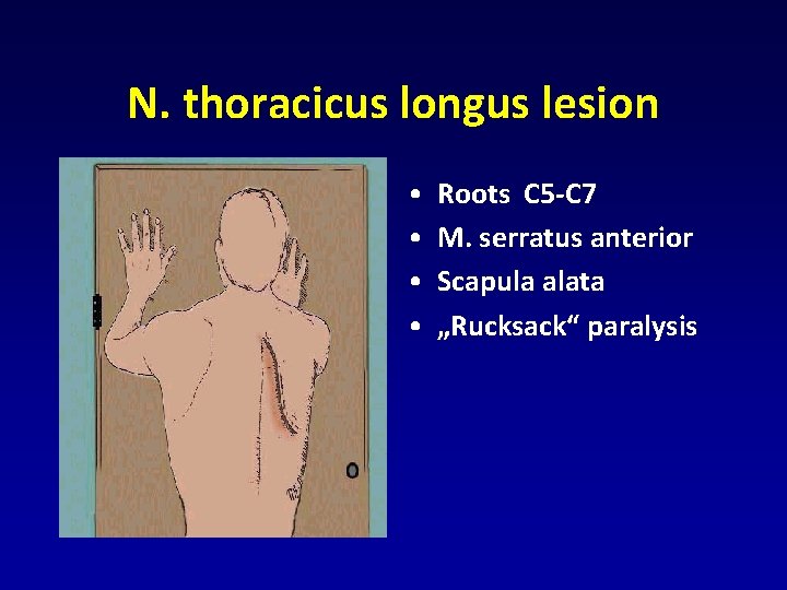 N. thoracicus longus lesion • • Roots C 5 -C 7 M. serratus anterior N. thoracicus longus lesion • • Roots C 5 -C 7 M. serratus anterior