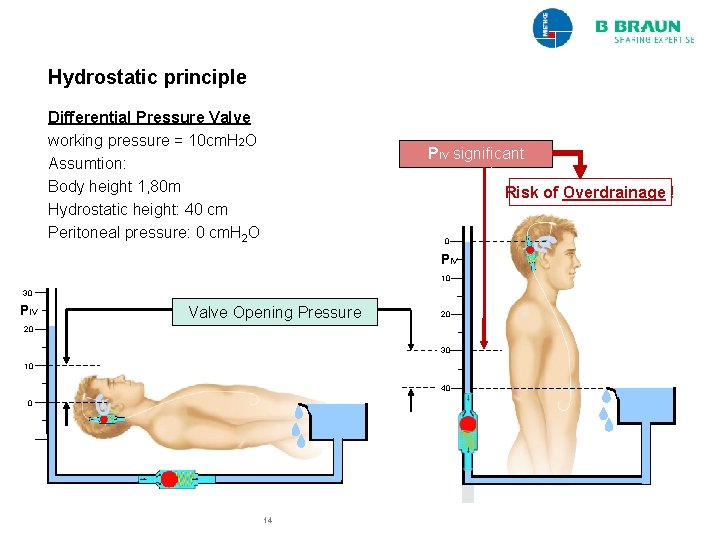 Hydrostatic principle Differential Pressure Valve working pressure = 10 cm. H 2 O Assumtion: