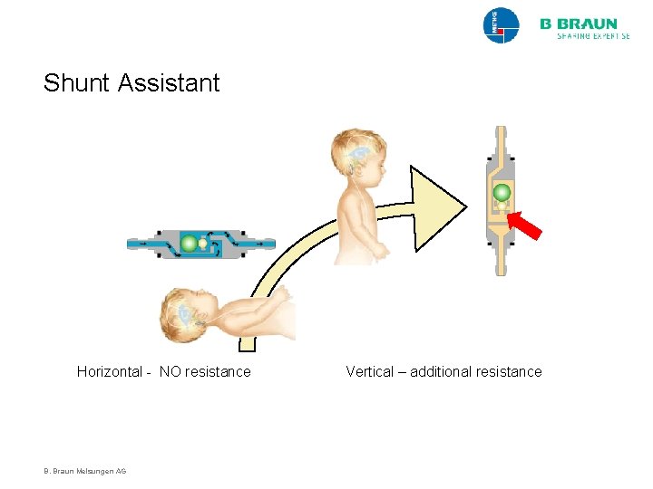 Shunt Assistant Horizontal - NO resistance B. Braun Melsungen AG Vertical – additional resistance