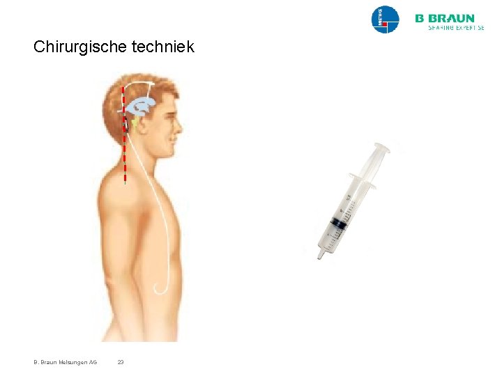 Chirurgische techniek B. Braun Melsungen AG 23 