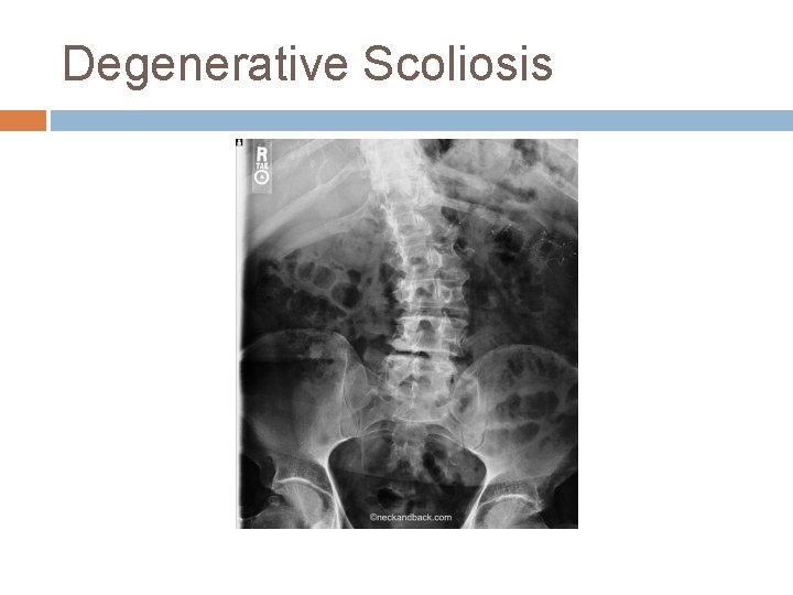Degenerative Scoliosis 