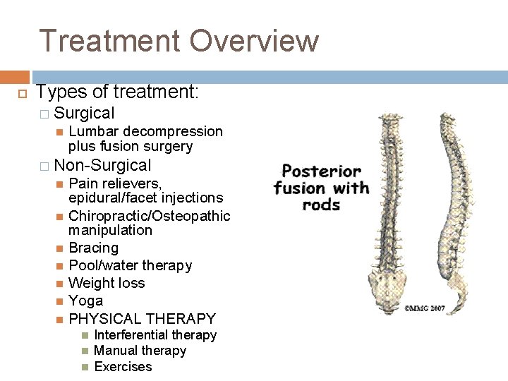 Treatment Overview Types of treatment: � Surgical Lumbar decompression plus fusion surgery � Non-Surgical