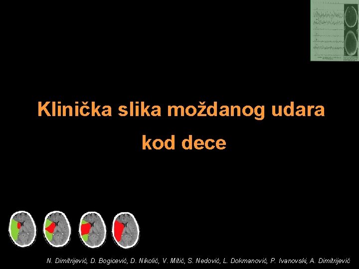 Klinička slika moždanog udara kod dece N. Dimitrijević, D. Bogicević, D. Nikolić, V. Mitić,