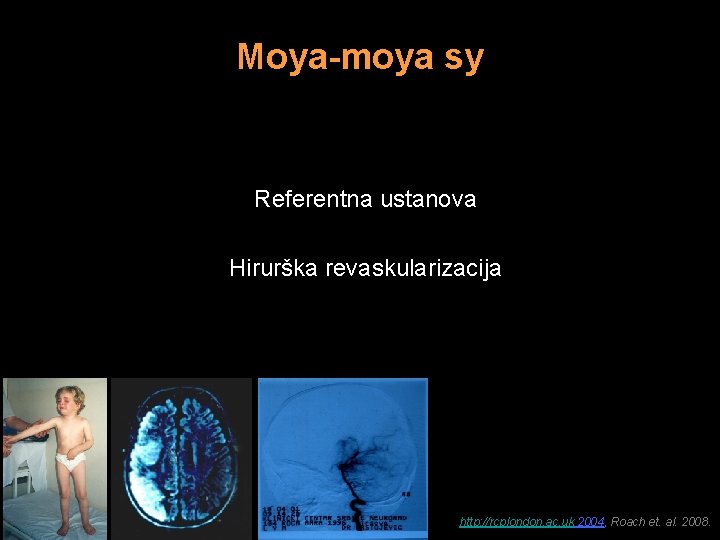 Moya-moya sy Referentna ustanova Hirurška revaskularizacija http: //rcplondon. ac. uk 2004, Roach et. al.