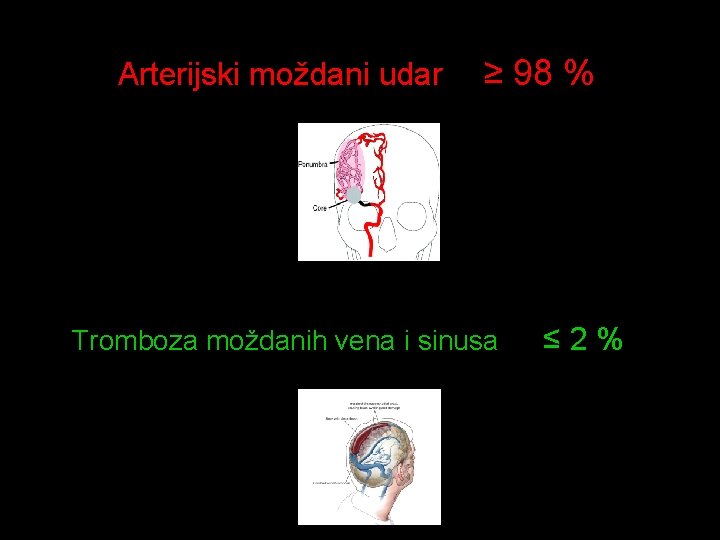 Arterijski moždani udar ≥ 98 % Tromboza moždanih vena i sinusa ≤ 2% 