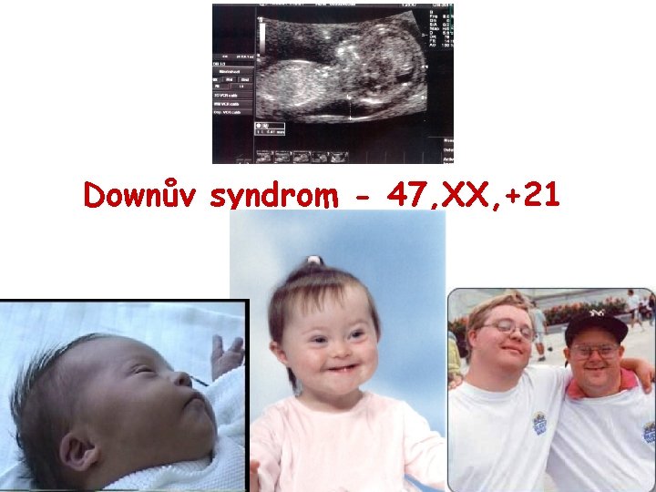 Downův syndrom - 47, XX, +21 